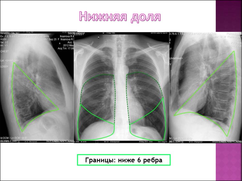 Уплотнение нижней доли легкого. Рентгеноанатомия грудной полости. Рентгеноанатомия грудной клетки. Заднебазальный сегмент легкого какие ребра.