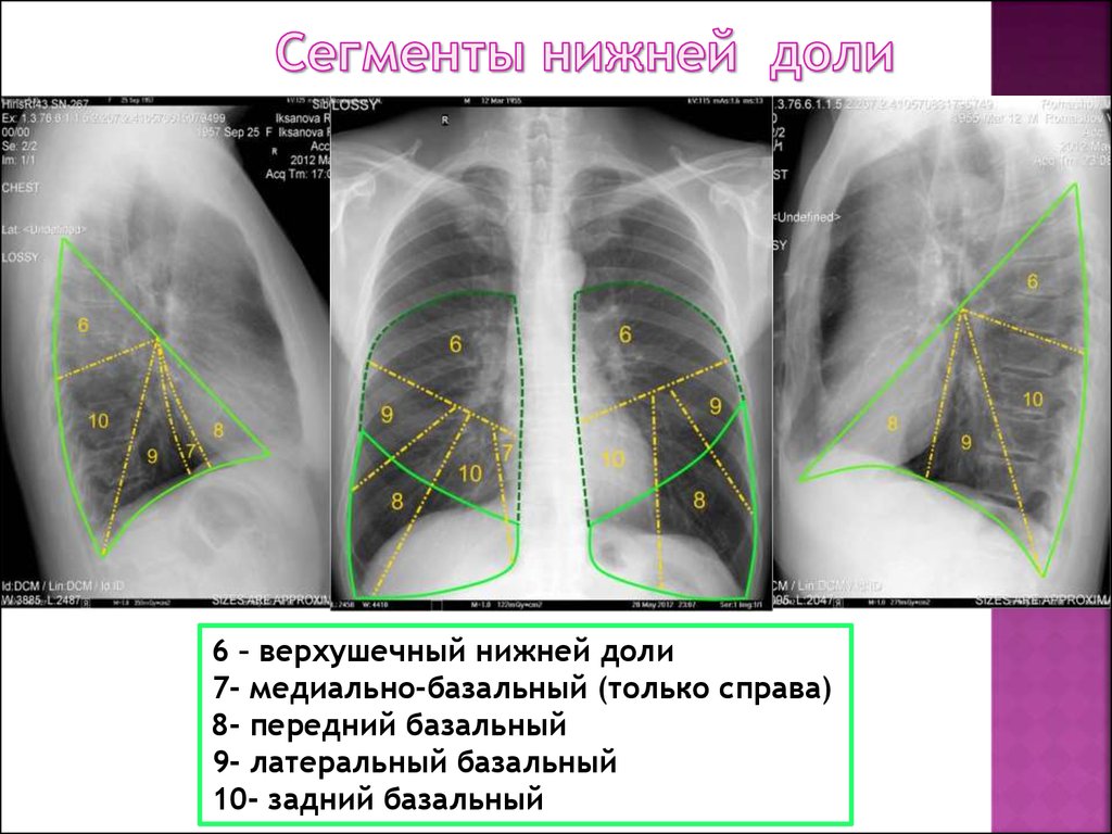 Язычковые сегменты левого. 6, 10 Сегмент правого легкого. S9 сегмент левого легкого.