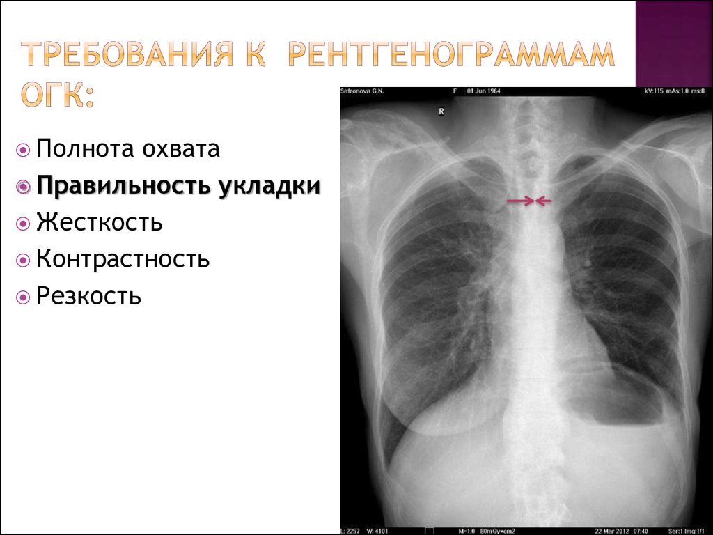 Огк это. Рентген ОГК норма. Рентгенография ОГК. Рентгенограмма органов грудной клетки. Нормальный рентген ОГК.