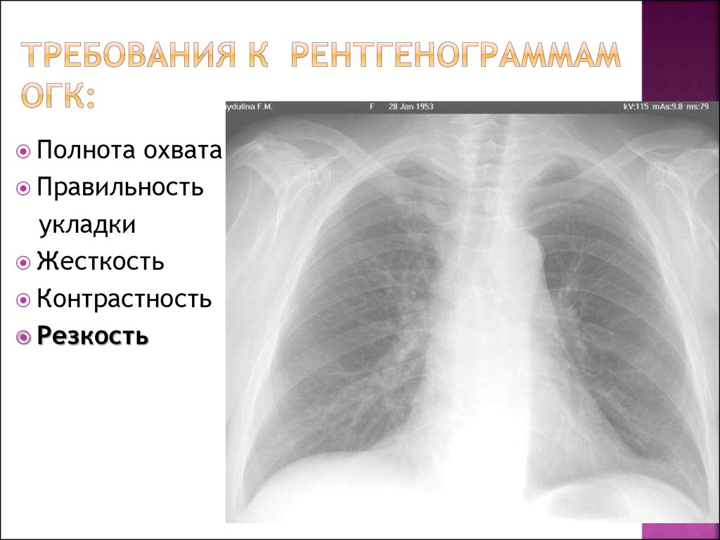 Огк это. РГ ОГК норма. Рентген анатомия ОГК. ОГК грудной клетки. Корень легкого рентгеноанатомия.