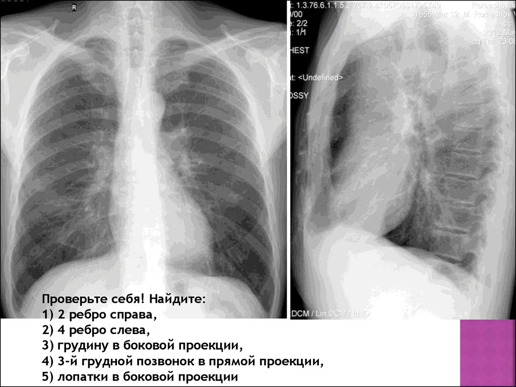 1 ребро справа. ФЛГ В двух проекциях. Снимок грудной клетки в 2 проекциях. Рентгеноанатомия грудной клетки. Рентген легких справа.