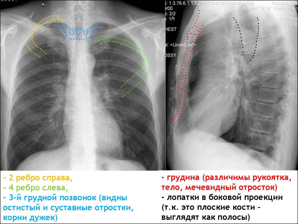 Боли в области правого легкого. Мечевидный отросток грудины рентген. Рентген ребер грудной клетки справа.