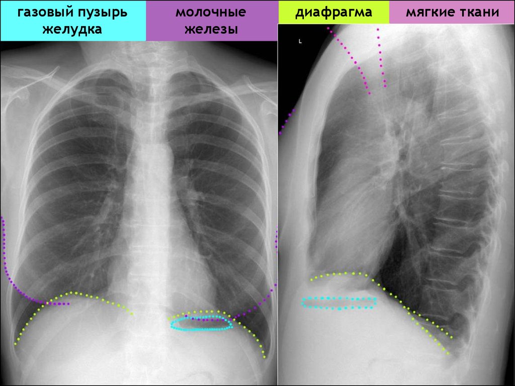 Диафрагмальная спайка. Газовый пузырь желудка на рентгене легких. Газовый пузырь на рентгенограмме. Газовый пузырь желудка на рентгене. Рентгеноанатомия диафрагмы.