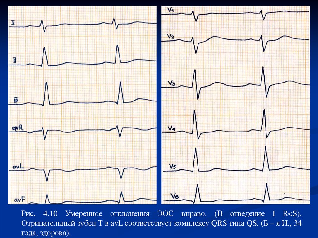 Эос отклонена вправо. Отрицательный т на ЭКГ В 1 отведении. Отрицательный зубец т в 1 и AVL. ЭКГ отрицательный зубец т в 1 отведении в AVL. ЭКГ отрицательный зубец т в III.
