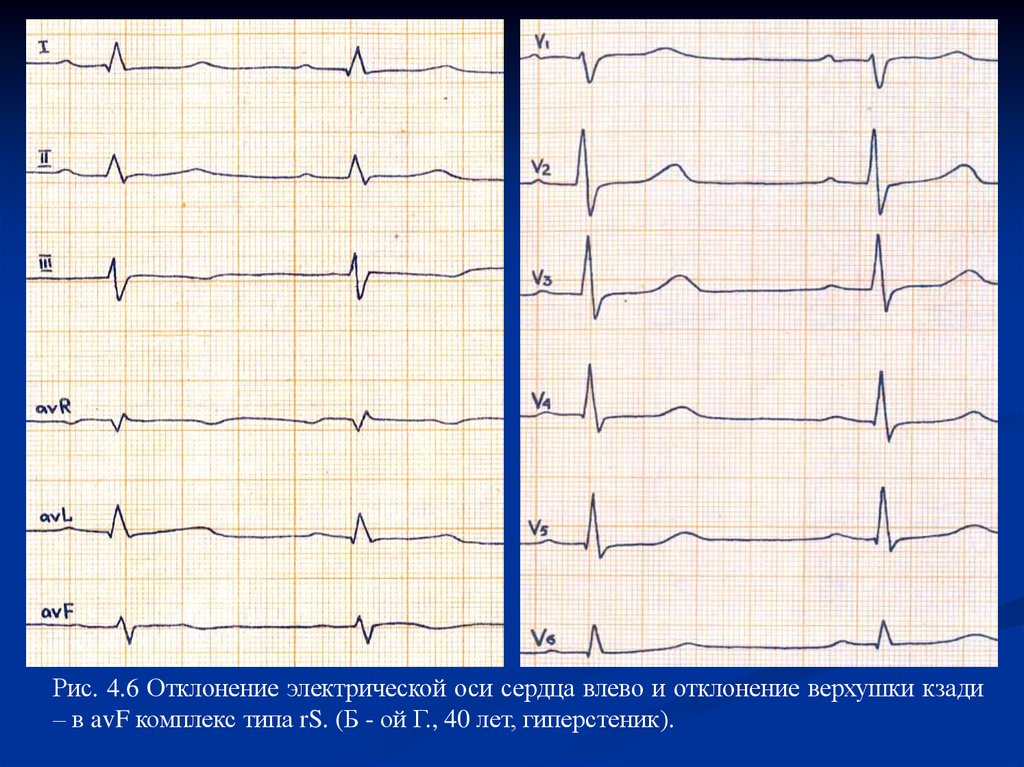 Экг отклонение влево у взрослого что это. Электрическая ось влево на ЭКГ. Отклонение оси влево на ЭКГ. ЭКГ v4 зубец t. Отклонение электрической оси влево на ЭКГ.
