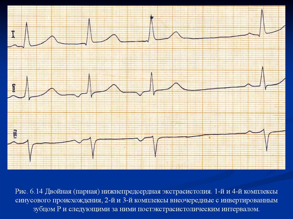 Парная наджелудочковая экстрасистола. АВ Узловая экстрасистолия на ЭКГ. Предсердная экстрасистолия на ЭКГ. Наджелудочковая экстрасистолия на ЭКГ. Нижнепредсердная экстрасистолия на ЭКГ.