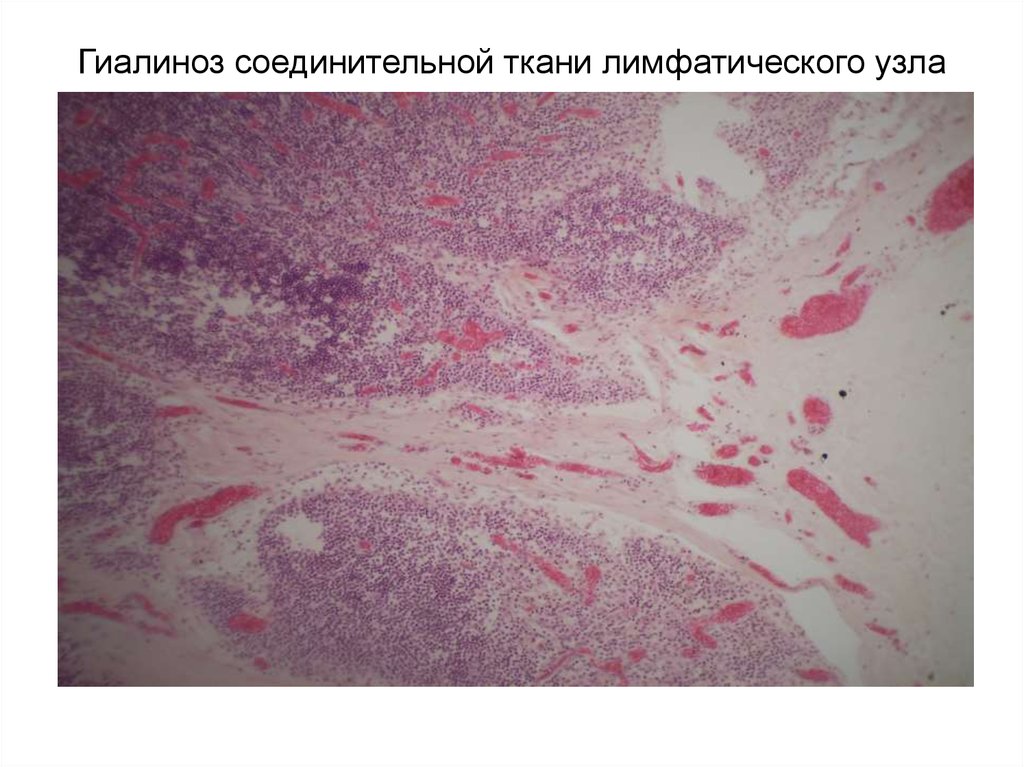 Гиалиноз соединительной ткани лимфатического узла