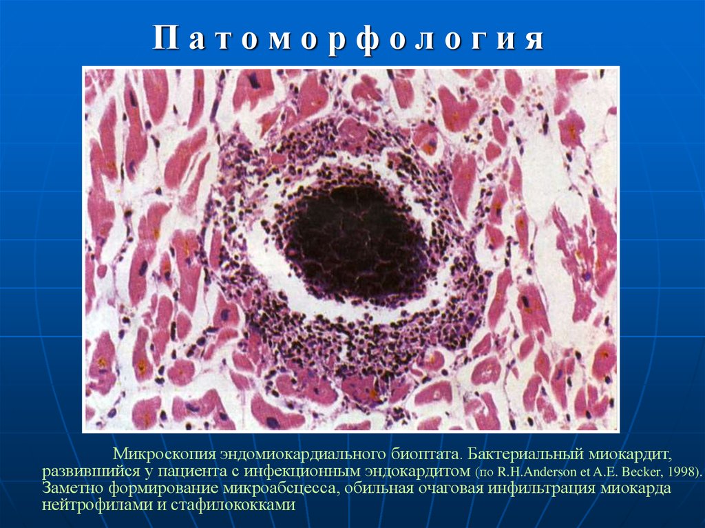 Биоптат. Инфекционный эндокардит морфология. Инфекционный эндокардит микропрепараты. Затяжной септический эндокардит патанатомия. Бактериальный (септический) эндокардит патанатомия.