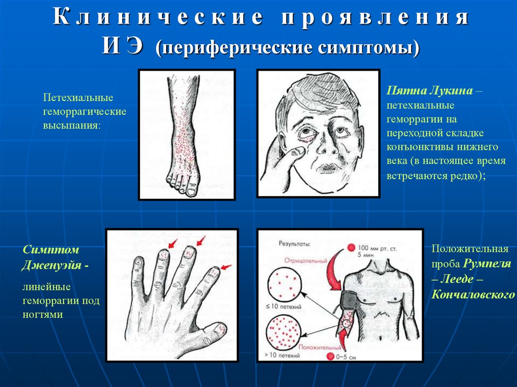 Симптом воздушной ловушки на компьютерных томограммах визуализируется как