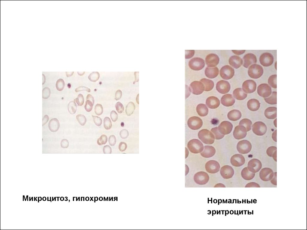 Гипохромия железодефицитная анемия. Гипохромная анемия в мазке крови. Микроцитарная анемия картина крови. Гипохромная анемия эритроциты. Микроцитоз и гипохромия эритроцитов в крови.