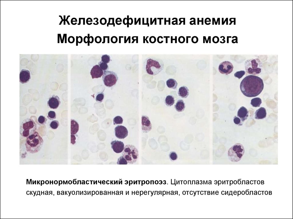 Для железодефицитной анемии характерна такая картина периферической крови