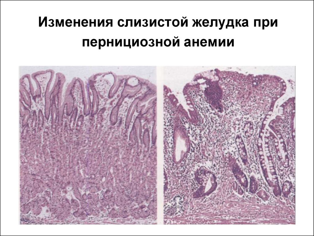 Слизистая атрофична. Атрофия слизистой оболочки желудка при анемии. В12-пернициозная анемия. Пернициозная анемия желудка. Атрофия слизистой оболочки желудка окраска гематоксилином.