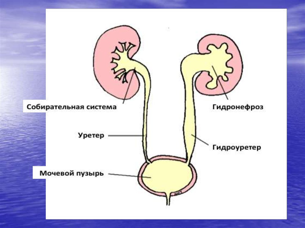 Что такое гидронефроз почки у взрослых. Гидроуретер мочеточника картинка.