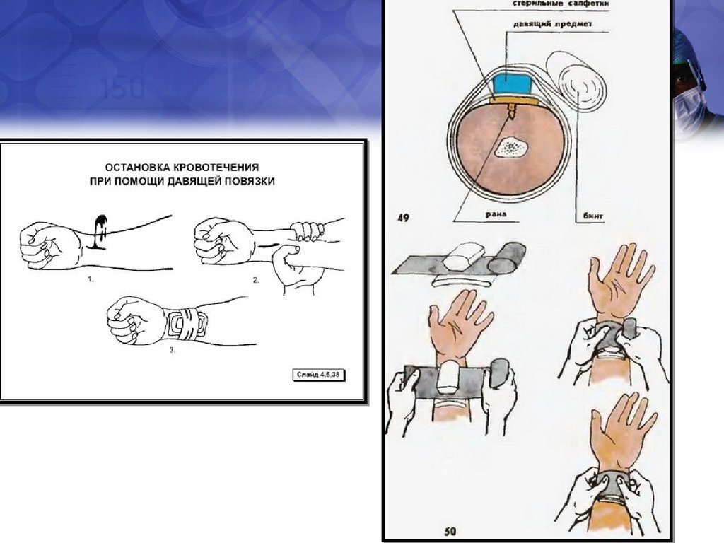 Ост предмет. Остановка кровотечения давящей повязкой алгоритм. Алгоритм выполнения давящей повязки. Манипуляция давящая повязка. Алгоритм наложение и фикспции давящей повязки.