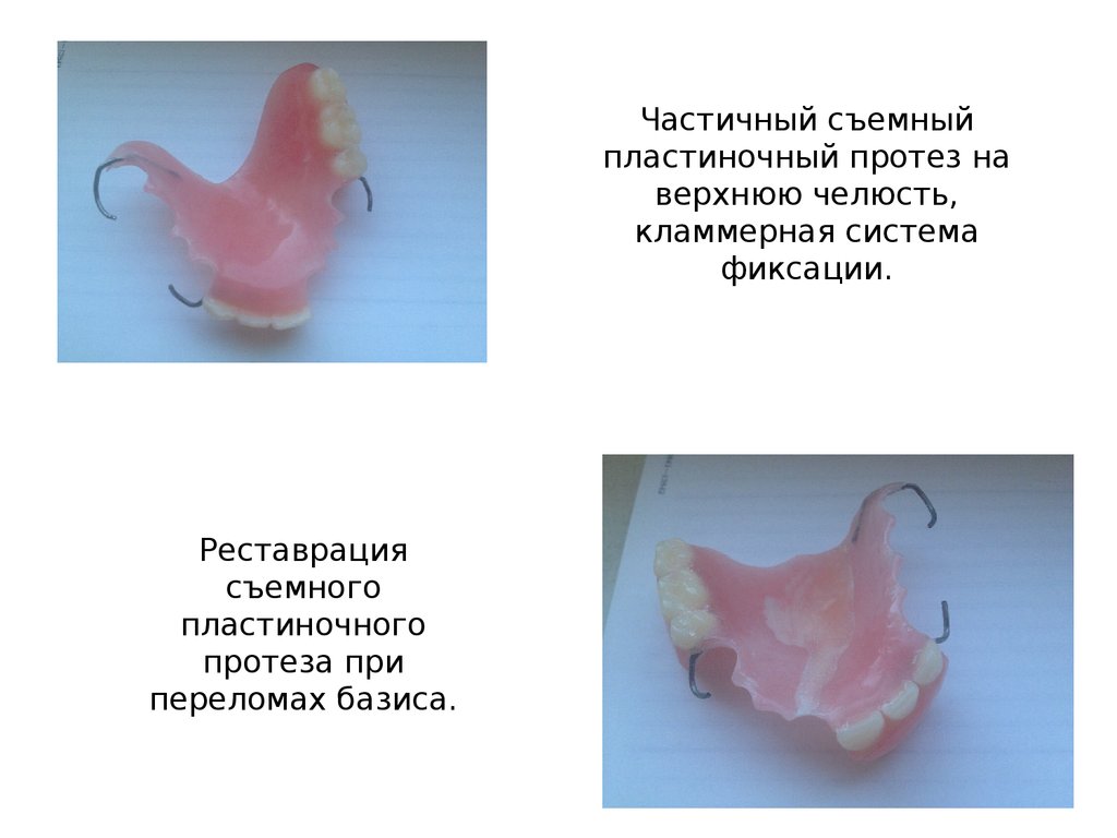 Съемные протезы презентация