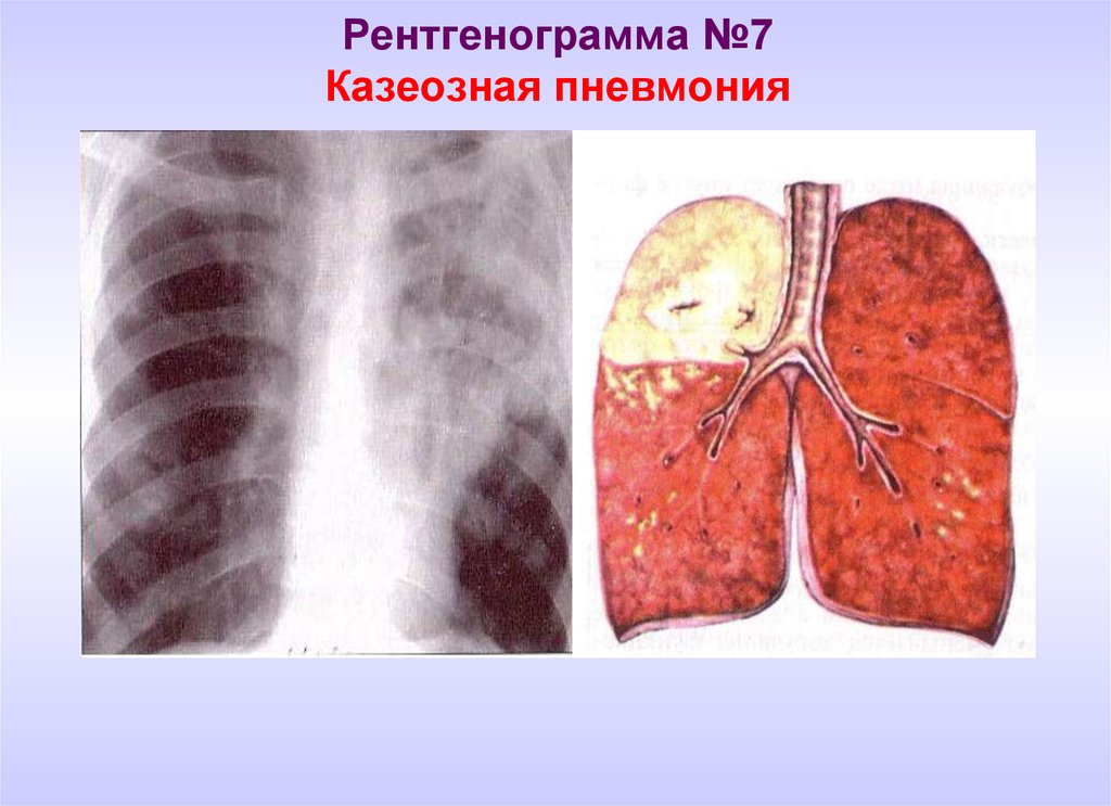 Распад легкого. Казеозная пневмония макропрепарат. Казеозная пневмония туберкулез рентген. Казеозная и крупозная пневмония. Казеозная пневмония легких рентген.