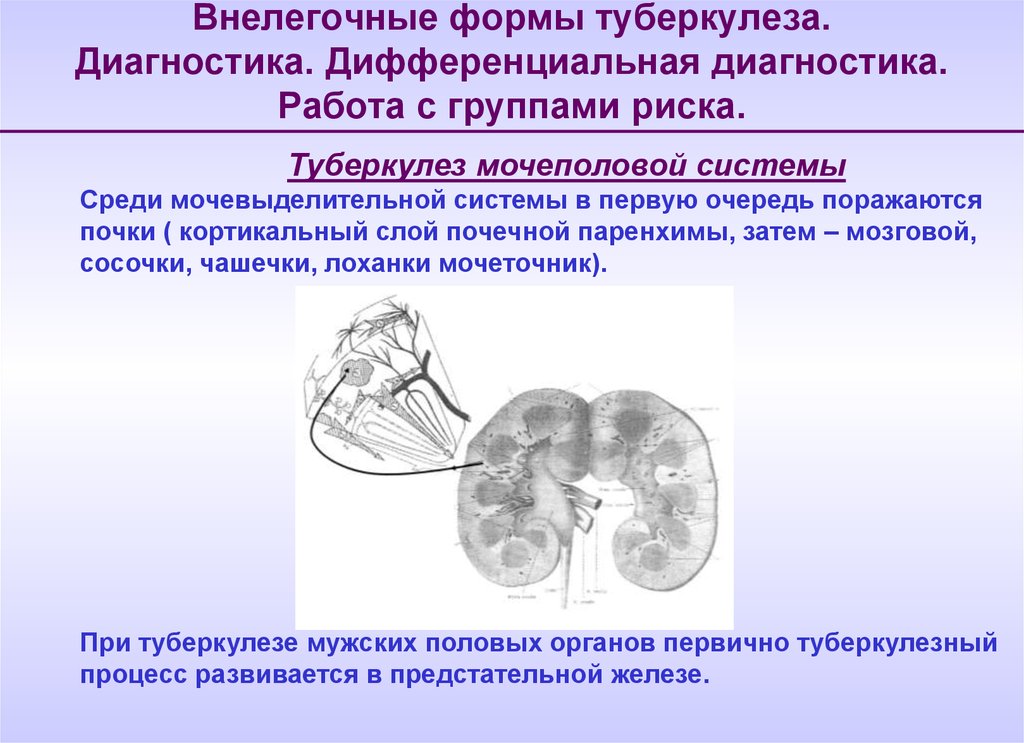 Туберкулез мочевой системы