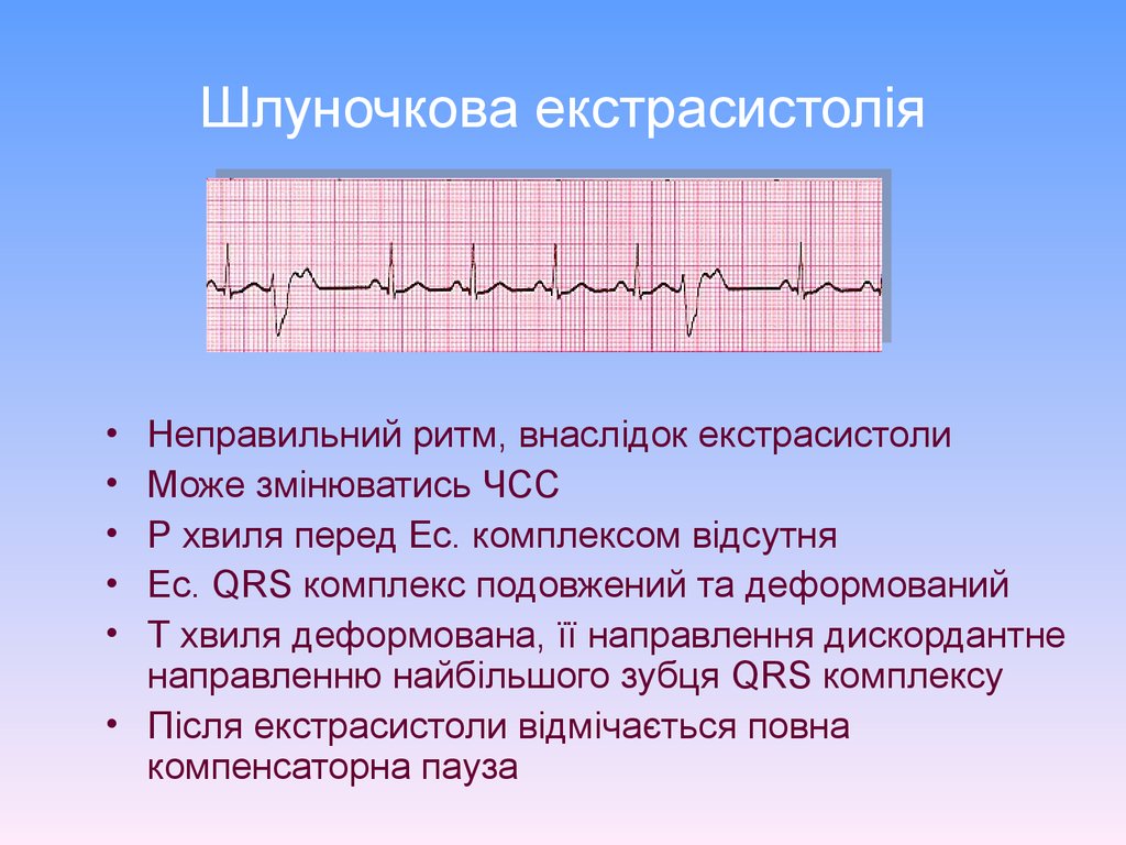 Гиперкалиемия на экг фото