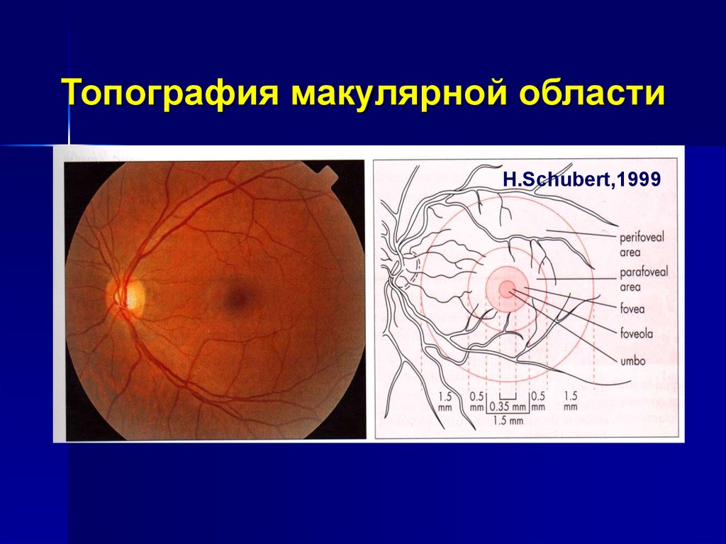 Клиническая картина металлоза глаза может быть вызвана