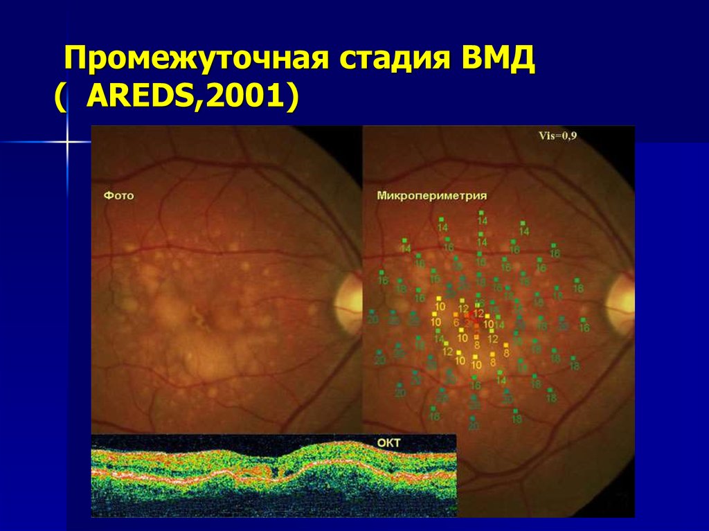 Возрастная макулярная дегенерация презентация