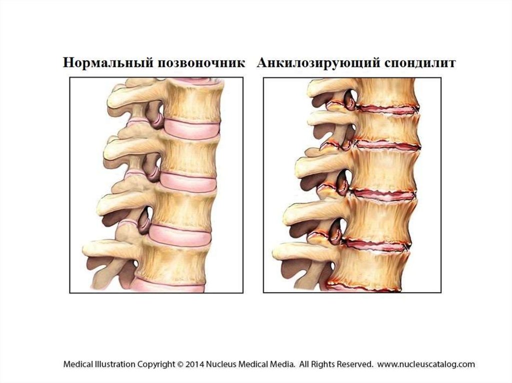 Спондилоартроз лечение. Спондилез клиника. Давление и спондилез. Спондилез растет вовнутрь. Остеофиты как формируются.