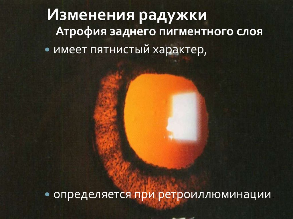 Изменения радужки