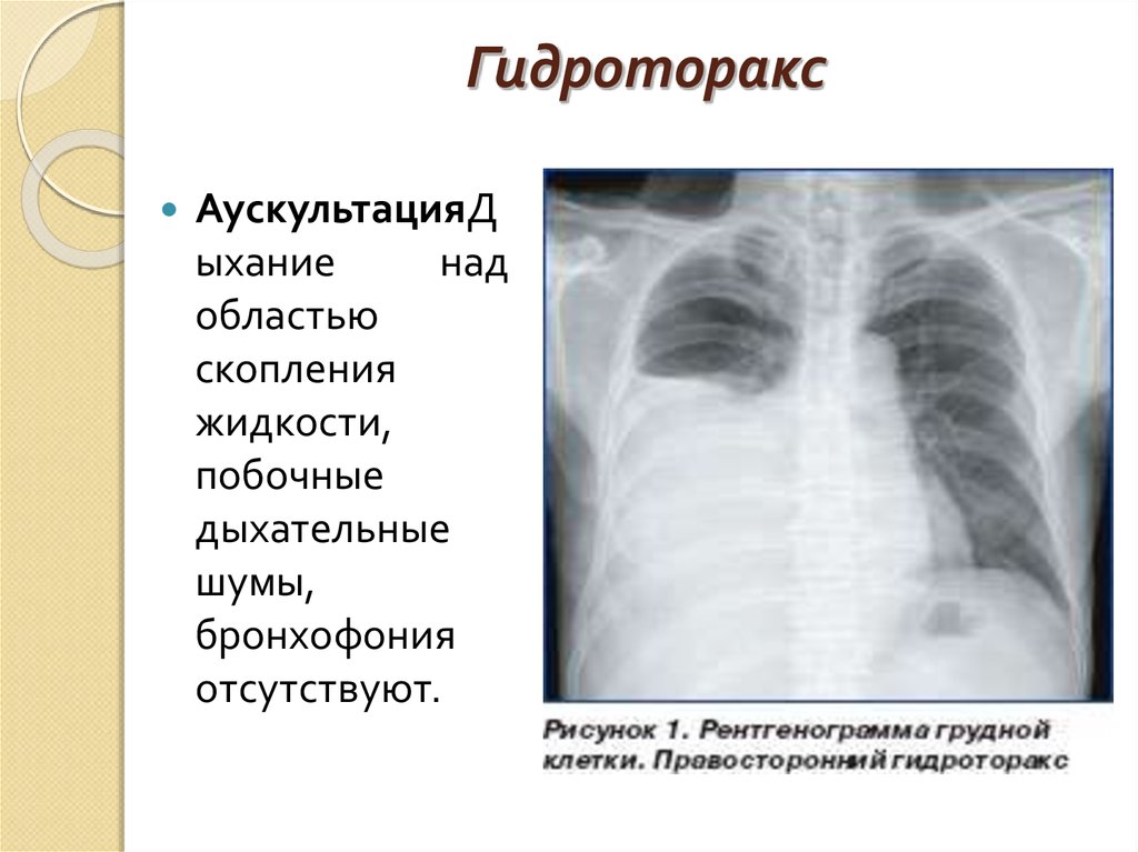 Что такое гидроторакс. Рентгенография грудной клетки при плеврите. Гидроторакс снимок рентген. Правосторонний малый гидроторакс. Гидроторакс рентген снимки.