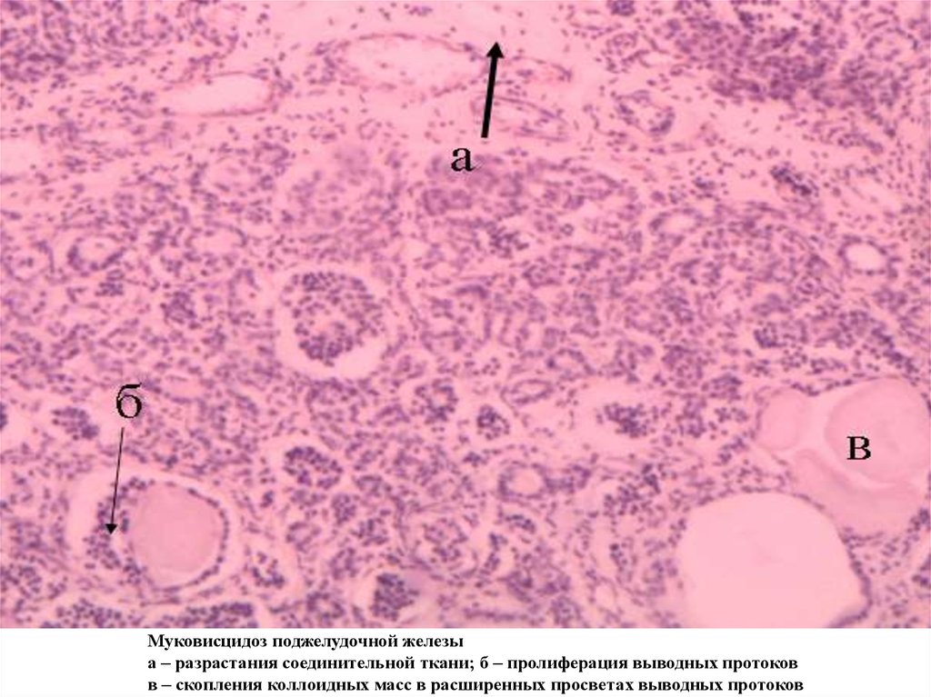 Фиброз желез. Поджелудочная железа при муковисцидозе микропрепарат. Муковисцидоз поджелудочной железы микропрепарат. Муковисцидоз патанатомия поджелудочная железа. Печень при муковисцидозе микропрепарат.
