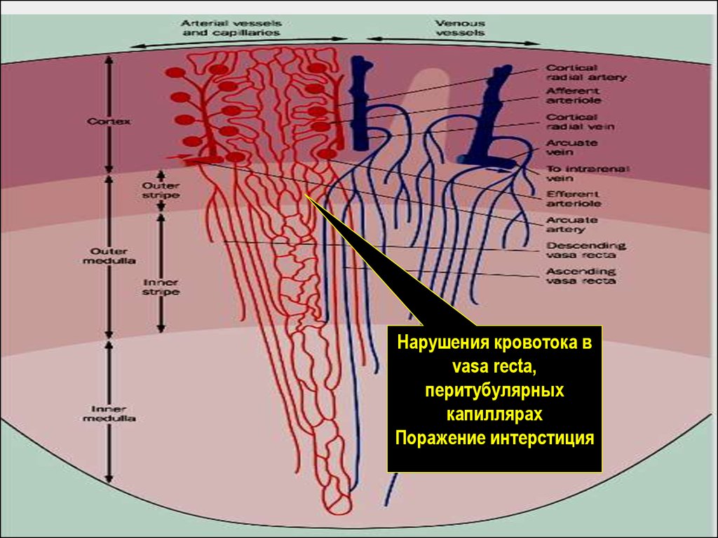 Нарушение кровотока. Перитубулярные капилляры. Нарушение почечной гемодинамики. Нарушения кровоснабжения почек.