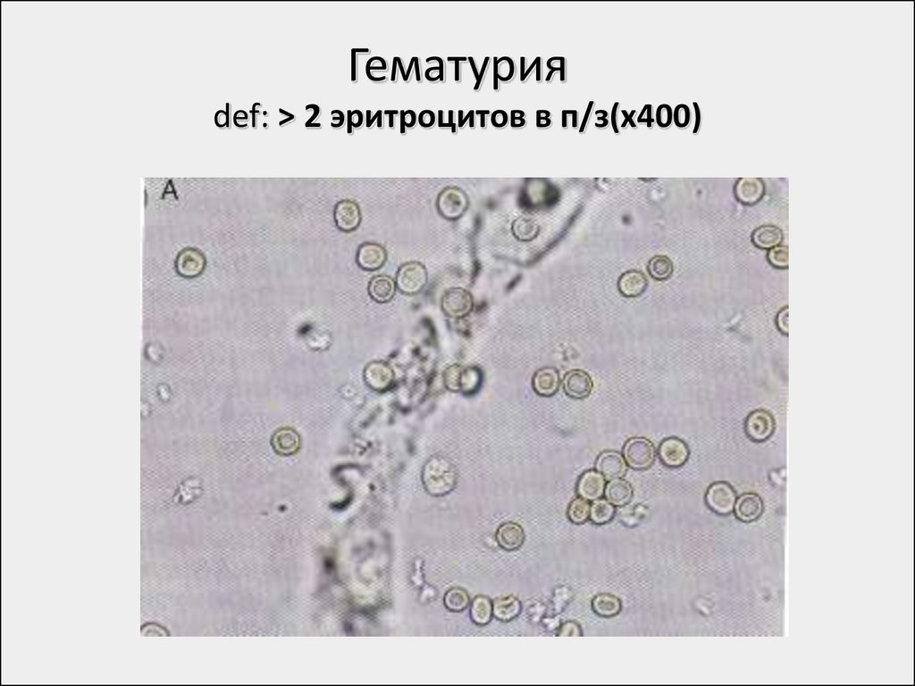 Эритроциты в моче. Выщелоченные эритроциты в моче. Измененные эритроциты выщелоченные. Выщелоченные эритроциты в моче под микроскопом. Гематурия выщелоченные эритроциты.