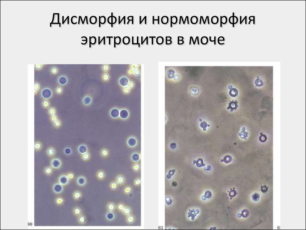 Измененные эритроциты в моче фото