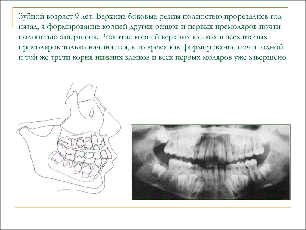 Год верхних. Верхние боковые резцы как прорезываются. Верхние боковые резцы. Зубной Возраст. Зубной Возраст презентация.