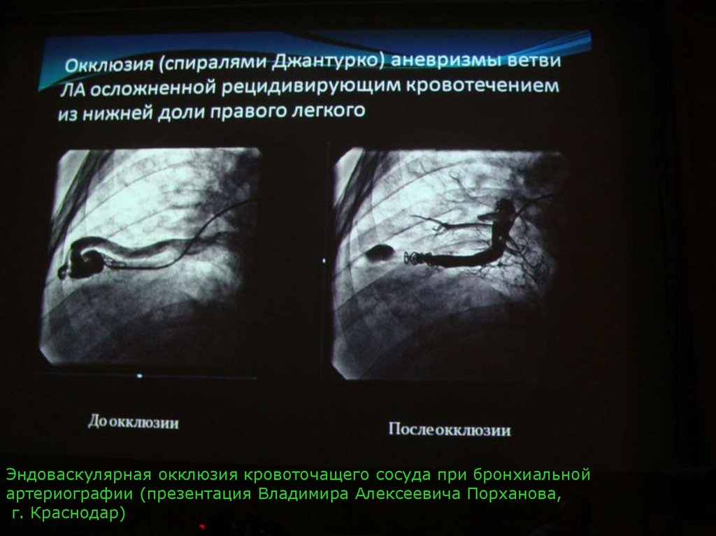 Эндоваскулярная окклюзия. Рентгенэндоваскулярная окклюзия. Эндоваскулярная окклюзия бронхиальных артерий. Окклюзия аневризмы микроспиралями. Оентгеноэндоваскулярнач окулюзия.