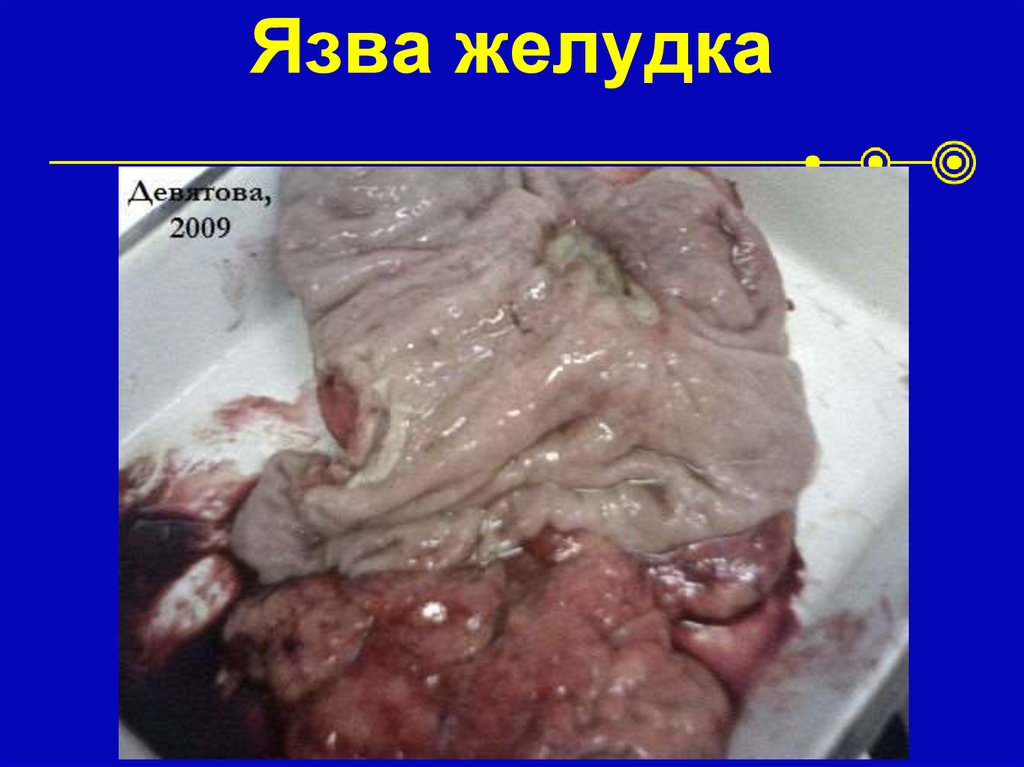 Язва желудка