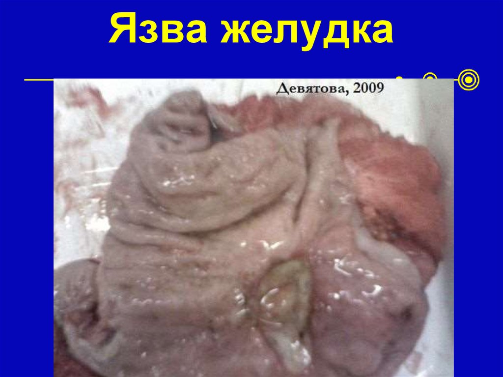 Язва желудка