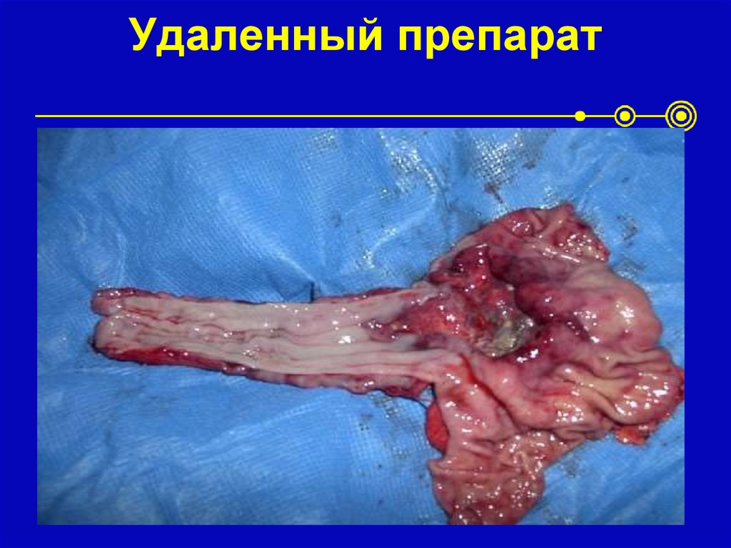 Удаленный препарат