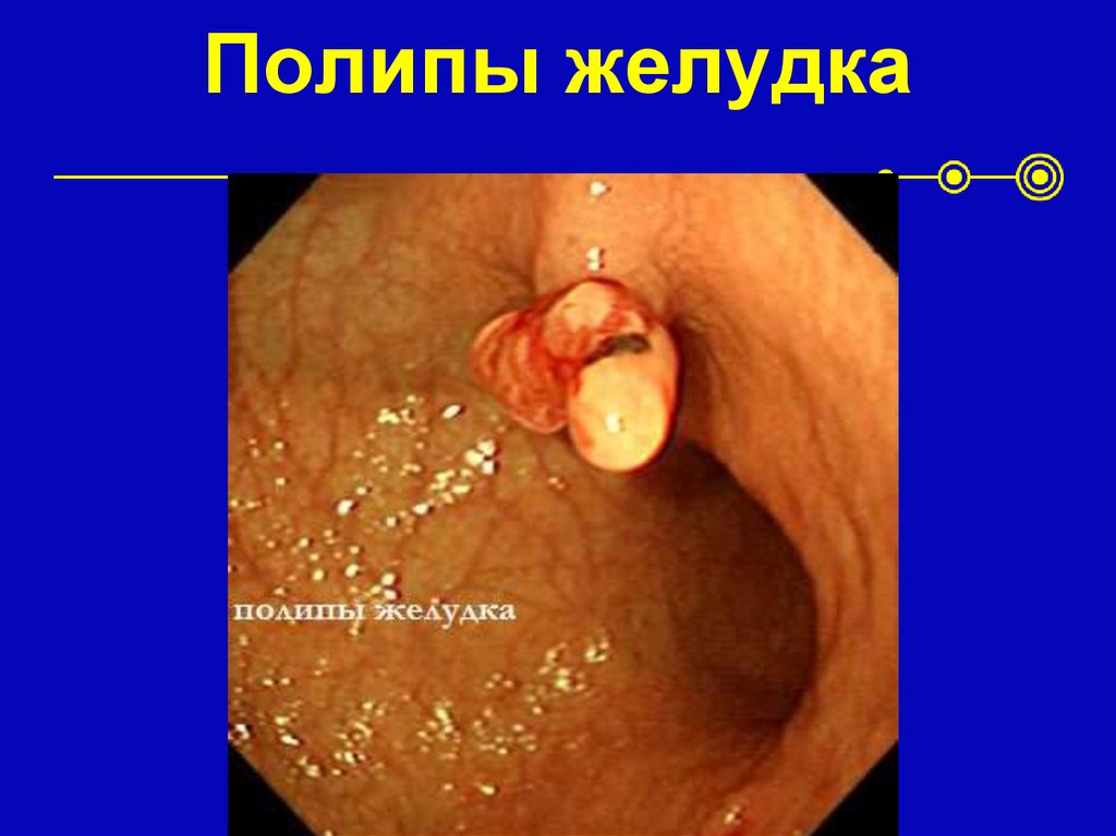 Полипы желудка