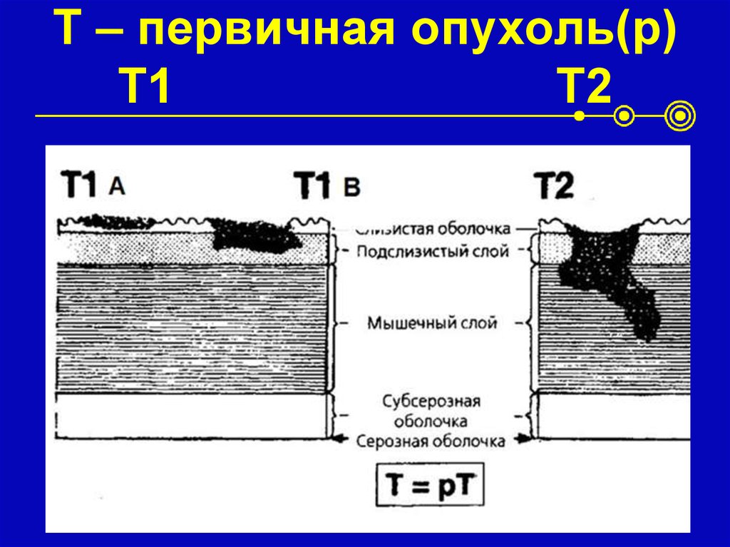 T – первичная опухоль(p) T1 T2
