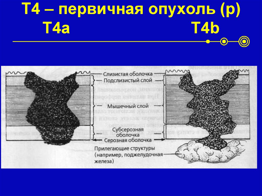 T4 – первичная опухоль (p) T4a T4b
