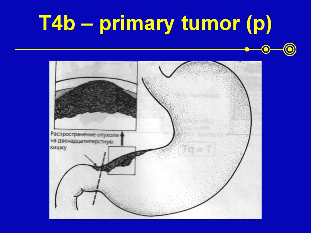 T4b – primary tumor (p)