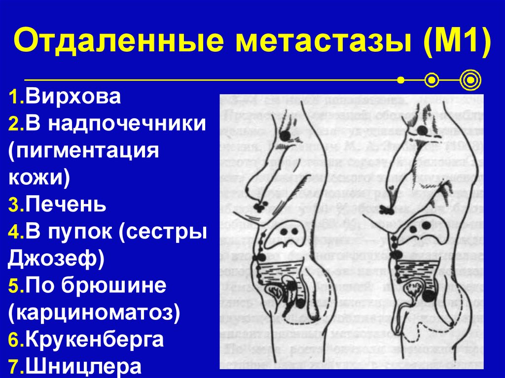 вирховские метастазы. вирховские метастазы. рпк желудка метастазирование. вирховские метастазы. заболевания жкт патологическая анатомия.