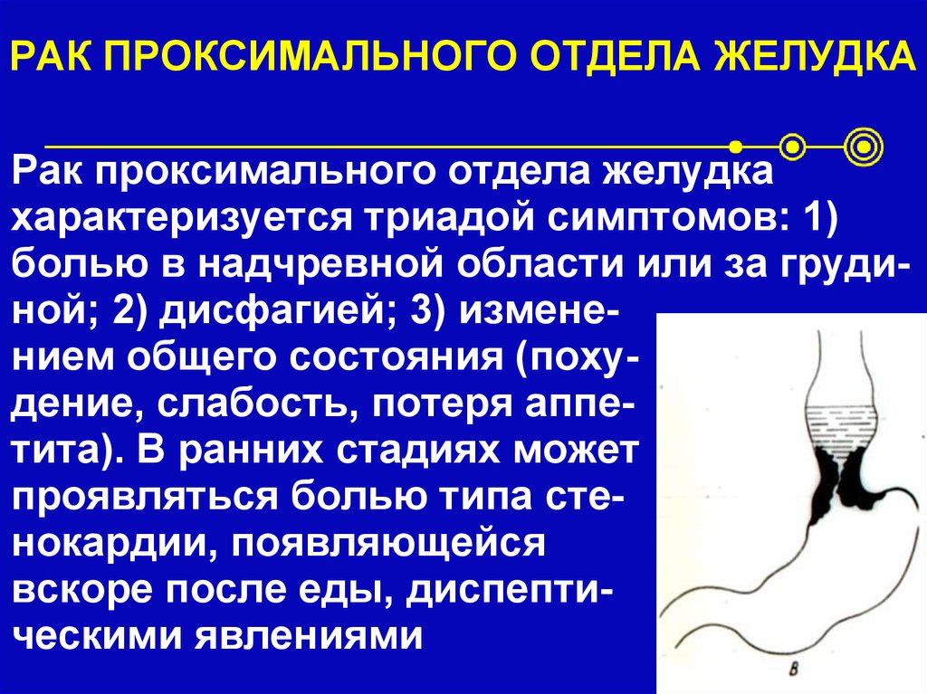 РАК ПРОКСИМАЛЬНОГО ОТДЕЛА ЖЕЛУДКА