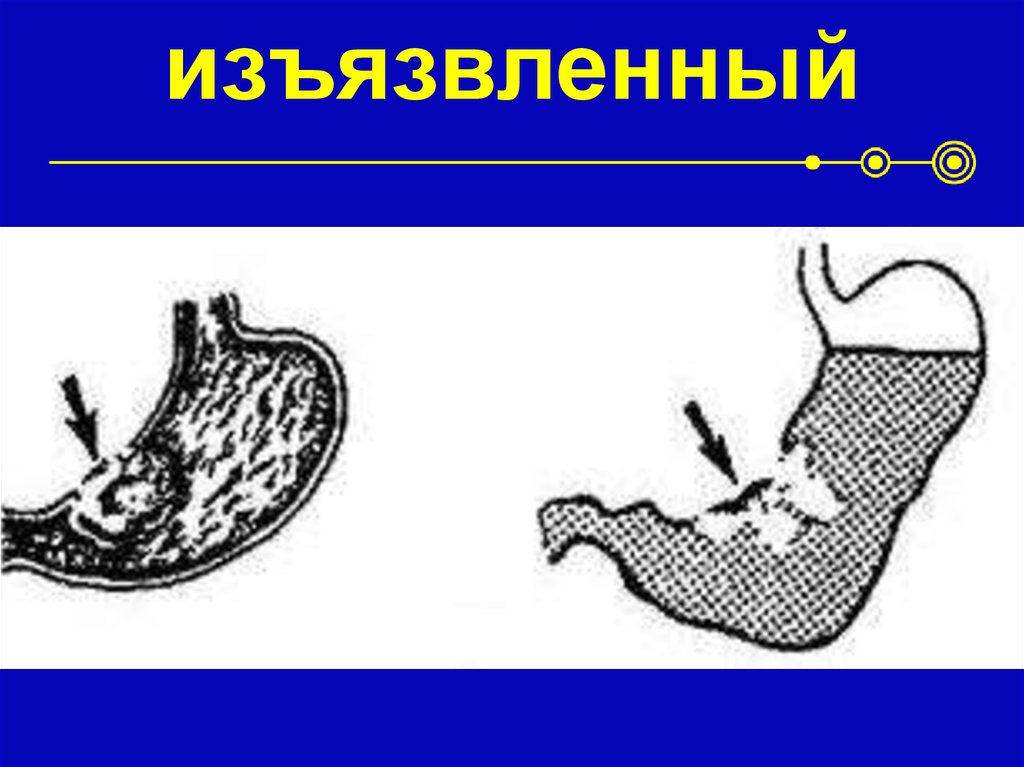 изъязвленный