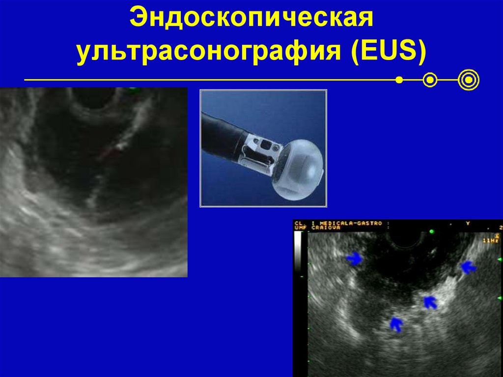 Узи эндоскопия. Эндоскопическое УЗИ пищевода. Эндоскопическая сонография. Эндоскоп ультрасонография. Эндоскопическая ультрасонография желудка.