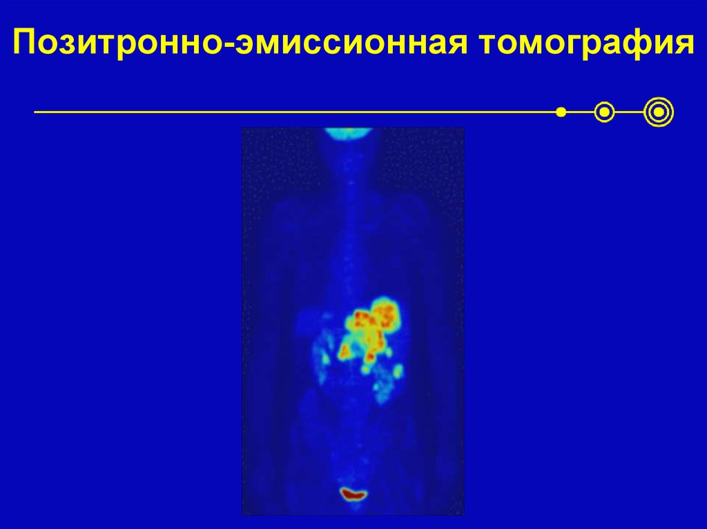 Позитронно-эмиссионная томография