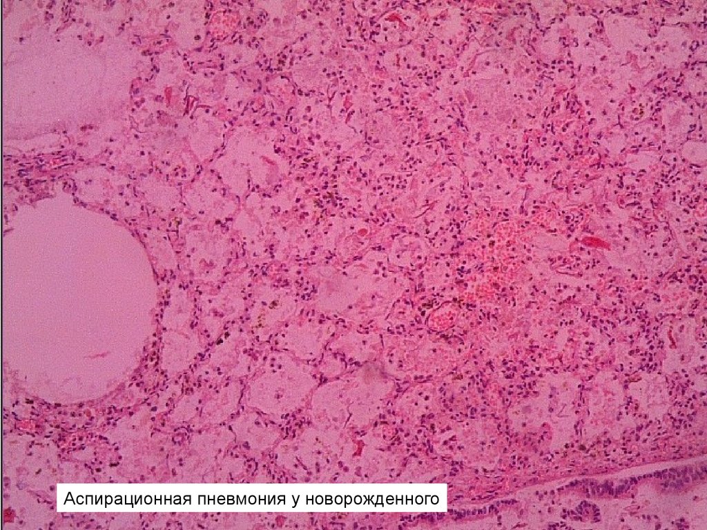 Аспирационная пневмония. Аспирационная пневмония микропрепарат. Абсцедирующая пневмония гистология. Аспирационная пневмония гистология. Абсцедирующая бронхопневмония микропрепарат.