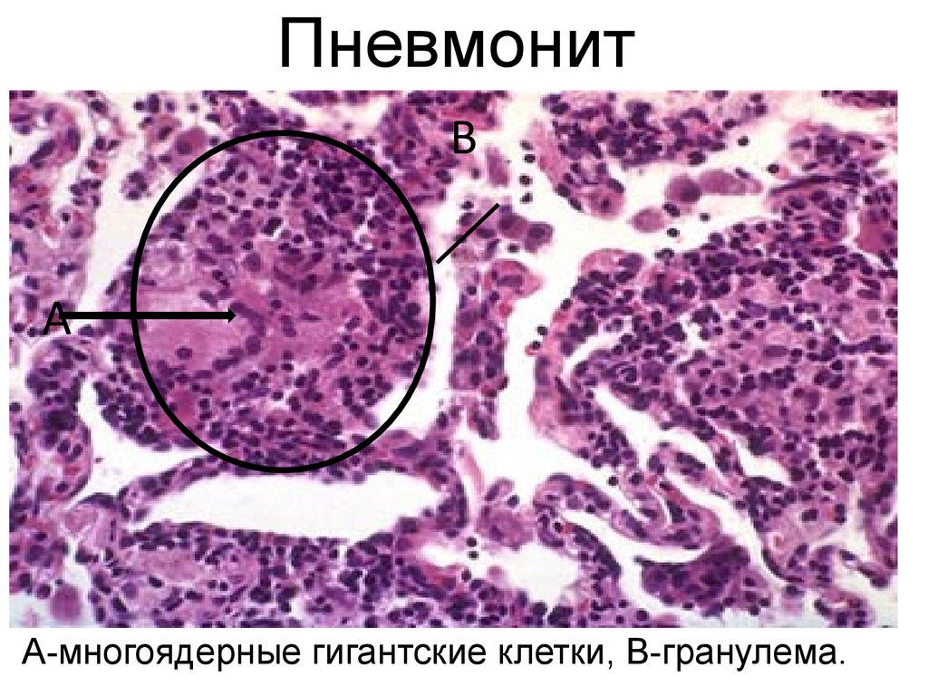 Пневмонит это. Гиперсенситивный пневмонит гистология. Гиперсенситивная пневмония. Альвеолярный пневмонит. Пневмония и пневмонит.