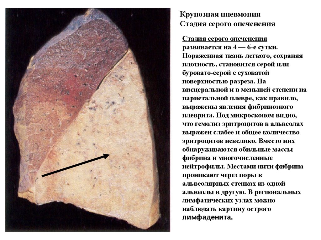 Крупозная пневмония. Крупозная пневмония макропрепарат. Крупозная пневмония стадия серого опеченения макропрепарат описание. Крупозная пневмония стадия опеченения. Крупозная пневмония стадия красного опеченения макропрепарат.