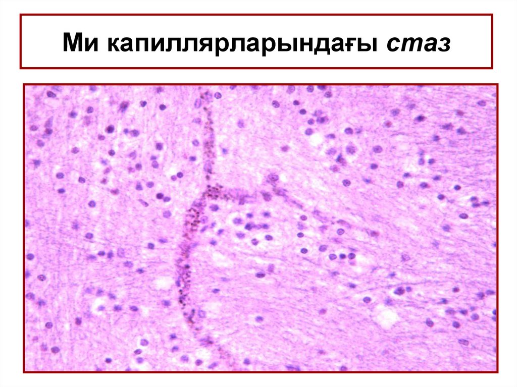 Стаз это