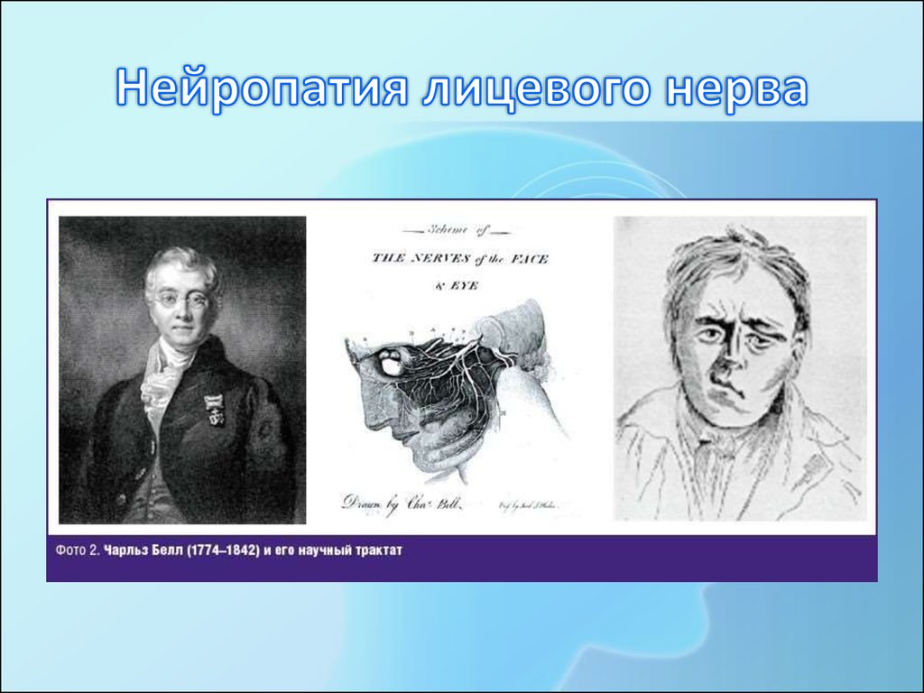 Неврит лицевого нерва мкб 10 код